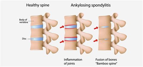 Diet Tips | Ankylosing spondylitis, Ankylosing spondylitis diet, Inflammatory arthritis