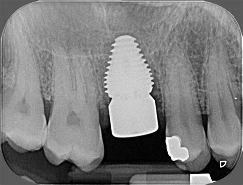 Molar Tooth Implant - Specialist Implant Clinic