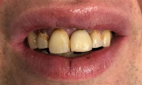 Ceramic Crowns Before & After Photos | Boerne TX