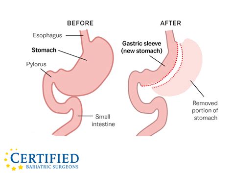 Gastric Sleeve Surgery | Certified Bariatric Surgeons