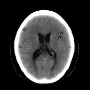 Neurocysticercosis | Radiology Reference Article | Radiopaedia.org