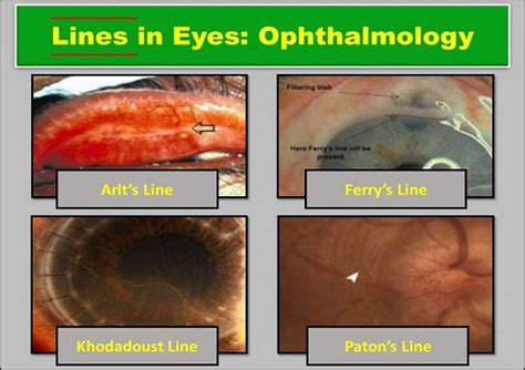 Lines in Eyes (Ophthalmology): Arlt's Line, Stocker, Schwalbe | Health Kura