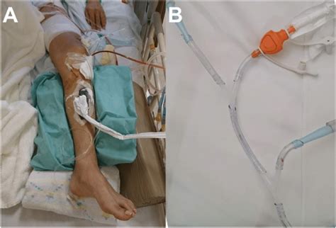 (A): An example of continuous local antibiotic perfusion (CLAP). A soft... | Download Scientific ...