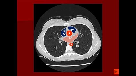 Normal Chest CT with labels - YouTube