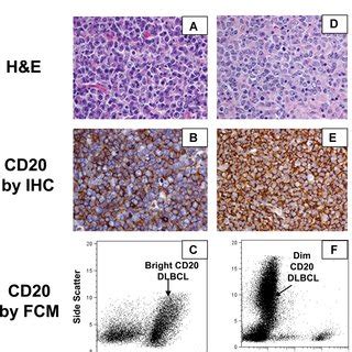 (PDF) Diffuse large B-cell lymphoma: Reduced CD20 expression is ...