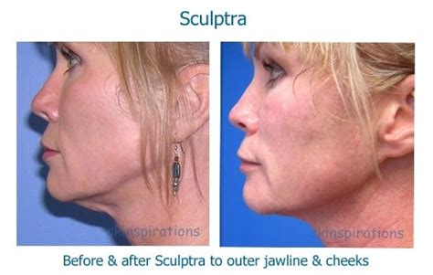 Sculptra jawline Archives - skinspirationsskinspirations