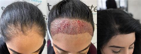 How Long Does it Take to Recover After a Hair Transplant? - Este