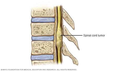 Spinal cord tumor - Symptoms and causes - Mayo Clinic