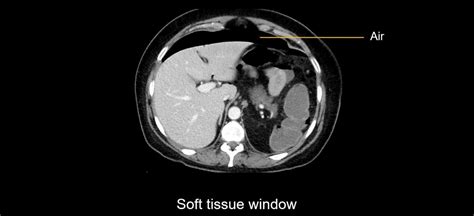 Abdominal CT: bowel perforation • LITFL • Radiology Library