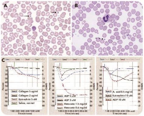 Abnormalities of platelet aggregation associated with giant granules in ...