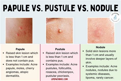 Papule vs Pustule vs Nodule: Pictures, Differences, and Causes