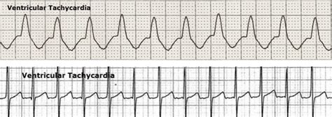 Pulseless Ventricular Tachycardia Ecg