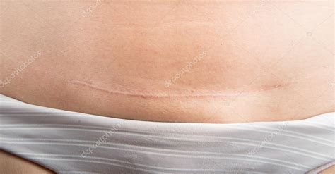 C section Cesarean operation heal after — Stock Photo © wckiw #76278151