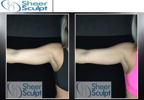 Before and After Coolsculpting Results - Sheer Sculpt - Coolsculpting in Philadelphia