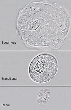 epithelial cells that can be found in urine | Medical Laboratories