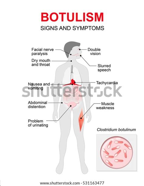 402 Botulism Toxin Images, Stock Photos & Vectors | Shutterstock