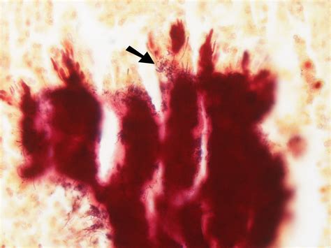 Actinomyces israelii - Microbiology - Medbullets Step 1