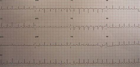 Pericardial effusion electrocardiogram - wikidoc