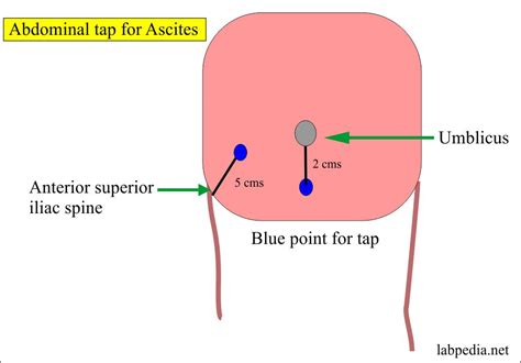 Fluid Analysis – Part 4 – Ascitic fluid, Peritoneal tap, abdominal paracentesis, abdominal tap ...