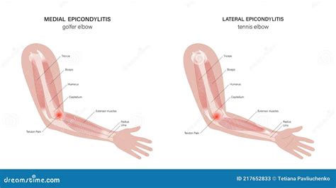 Medial Epicondylitis Golfer Elbow Cartoon Vector | CartoonDealer.com #218741817