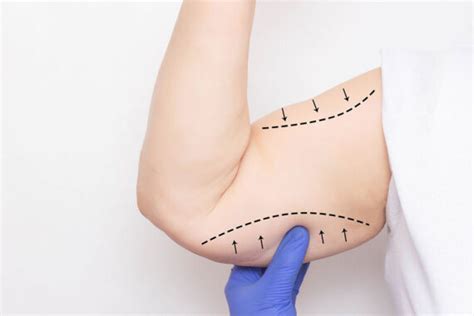 Arm Lift Recovery: Tips and What to Expect After Surgery