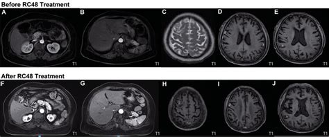 Comparison of MRI prior to (June, 2021) and after (December, 2021)... | Download Scientific Diagram