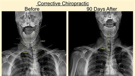 Chiropractic Adjustment Before And After