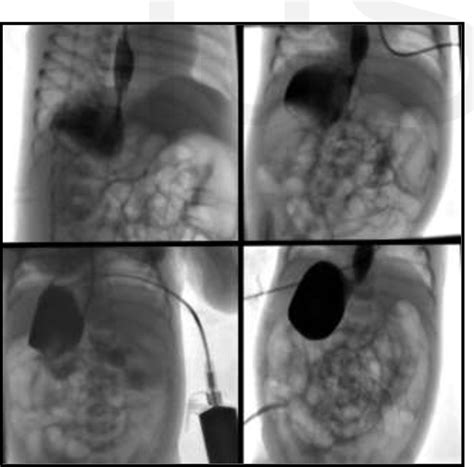 Heterotaxy Syndrome with Asplenia | Semantic Scholar