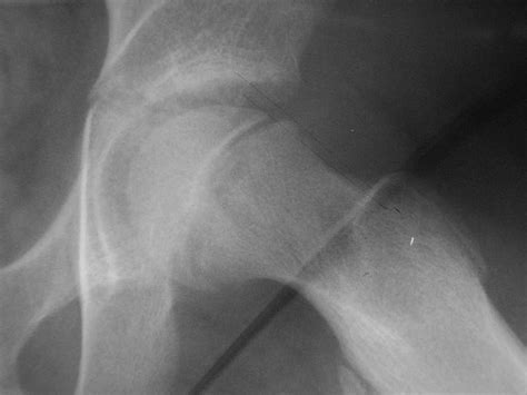 Slipped Capital Femoral Epiphysis (SCFE / SUFE) - almostadoctor