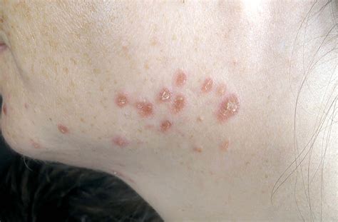 File:Cutaneous findings in systemic sarcoidosis.JPEG - Wikipedia