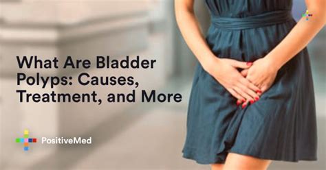 Bladder Polyps: Causes, Treatment, and More - PositiveMed