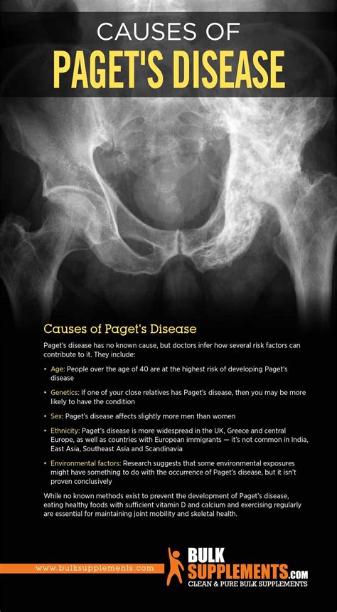 Paget’s Disease: Symptoms, Causes & Treatment by James Denlinger