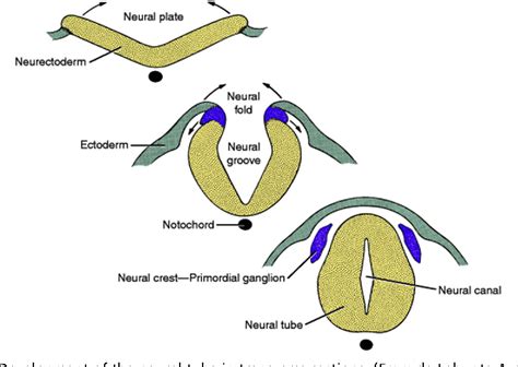 Figure 1 from Spina Bifida, Meningomyelocele, and Meningocele ...