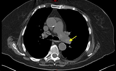 Pulmonary Embolism: Diagnosis by Computerized Tomography without ...