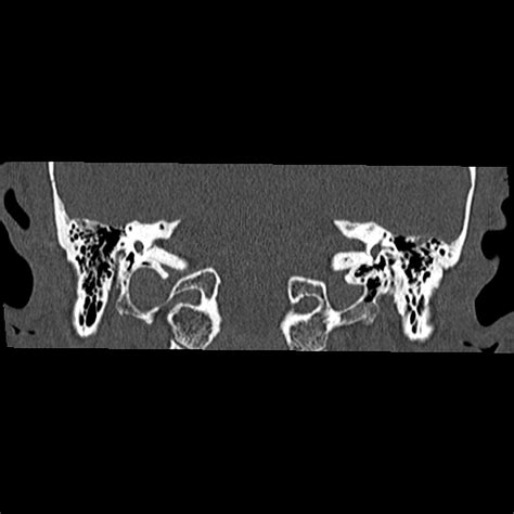 Normal petrous temporal bone CT | Image | Radiopaedia.org