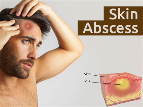 Skin Abscess: Causes, Symptoms, Diagnosis, Prevention And Treatment - Boldsky.com