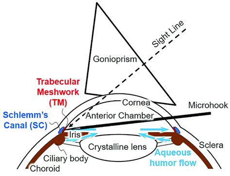 Anterior eye and minimally invasive glaucoma surgery (MIGS) procedure.... | Download Scientific ...