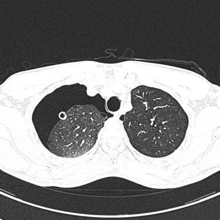 Pulmonary Bleb