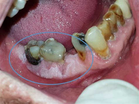 Leukoplakia - Titsinides Savvas - Oral Medicine - Oral Surgery Specialist