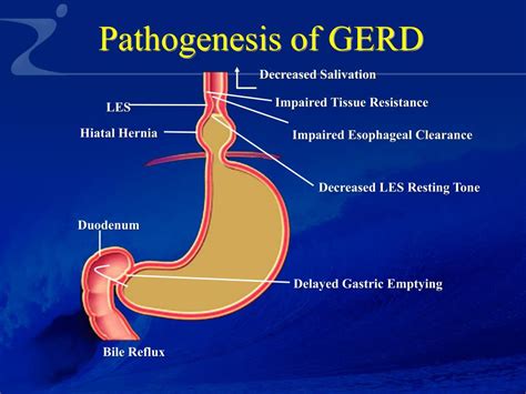 PPT - gastroesophageal reflux disease GERD PowerPoint Presentation, free download - ID:6865329