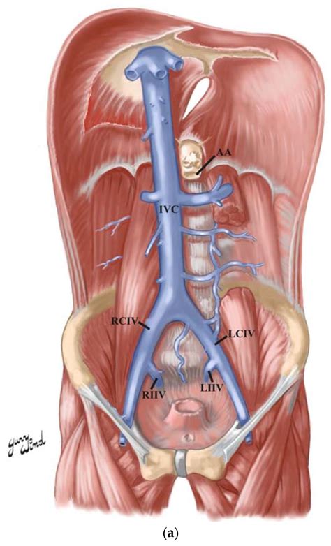 Anatomia | Free Full-Text | Duplicated Inferior Vena Cava in a 69-Year ...