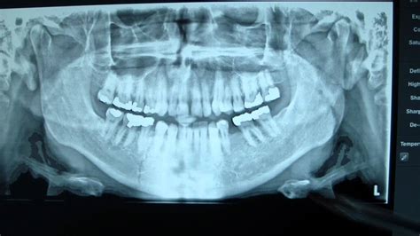 Mandibular Fracture X Ray
