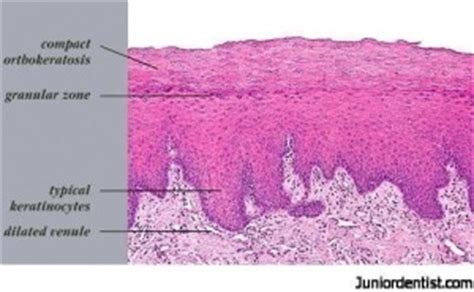 Leukoplakia | Leukokeratosis