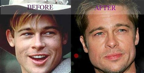 Brad Pitt plastic surgery - nose job, ear, eyelid surgery, facelift and ...