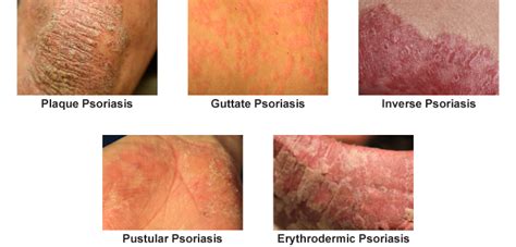 Chronic Psoriasis Treatment Orlando | Associates In Dermatology