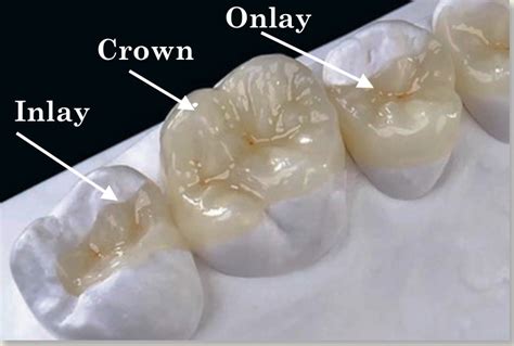 Dental Inlays and Onlays in New York City | JBL NYC