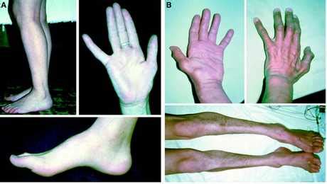 Spinal Muscular Atrophy - Life Expectancy, Treatment, Symptoms, Pictures