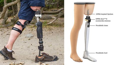 FDA Approves Implant for Adults with Above-the-Knee Amputations | Machine Design