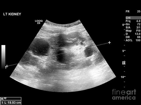 Polycystic Kidney, Ultrasound Scan Photograph by Science Photo Library ...