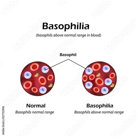 Basophils above the normal range in the blood. Basophilia. Infographics. Vector illustration ...